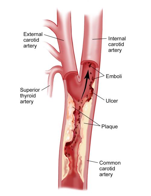 carotid-artery-disease-lemaitre